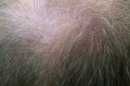 How to Conceal Thinning Hair Due to Male Pattern Baldness